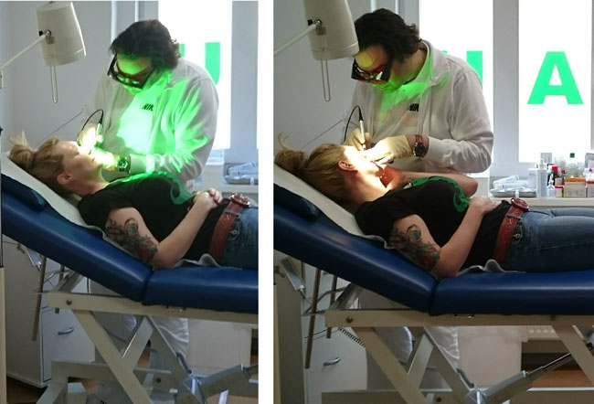 Rosacea laser treatment