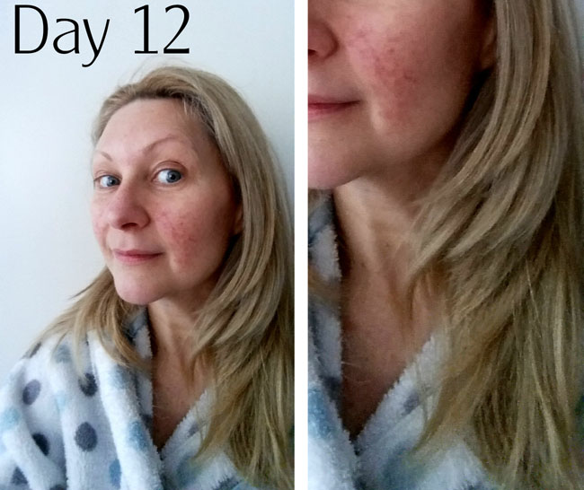 rosacea treatment after day 12