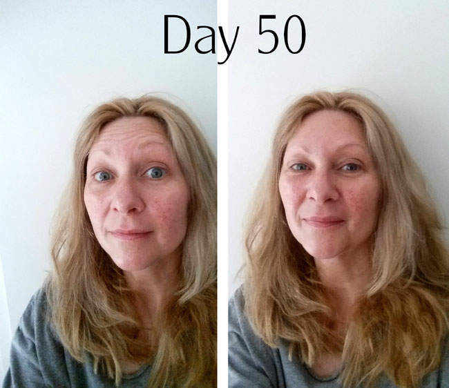 rosacea treatment after day 50