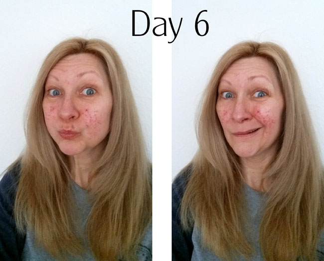 rosacea treatment after day 6